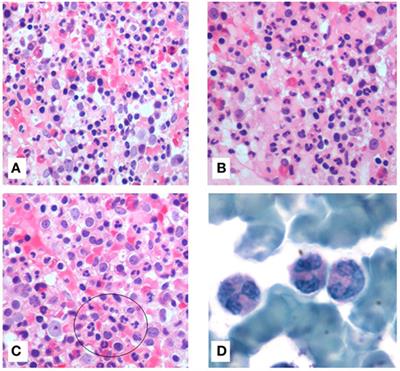 Dysplasia of Granulocytes in a Patient with HPV Disease, Recurrent Infections, and B Lymphopenia: A Novel Variant of WHIM Syndrome?